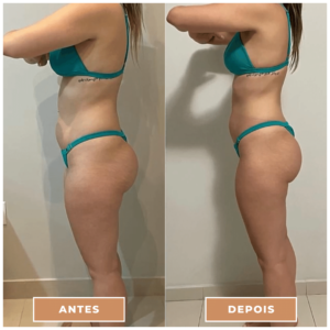 Antes e depois clnica performance Estética facial, Tratamentos corporais, preenchimentos, Massagens terapêuticas, Rejuvenescimento, Remoção de pelos, Contorno corporal, Terapias de bem-estar, Anti-envelhecimento, Estética avançada e muito mais procedimentos estéticos e saúde para seu corpo.