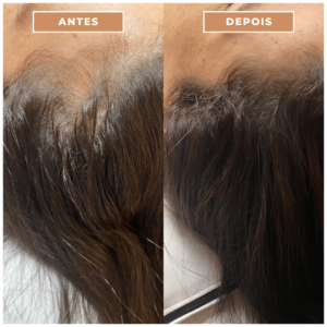 Antes e depois clnica performance Estética facial, Tratamentos corporais, preenchimentos, Massagens terapêuticas, Rejuvenescimento, Remoção de pelos, Contorno corporal, Terapias de bem-estar, Anti-envelhecimento, Estética avançada e muito mais procedimentos estéticos e saúde para seu corpo.