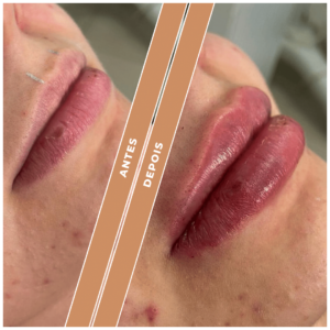Antes e depois clnica performance Estética facial, Tratamentos corporais, preenchimentos, Massagens terapêuticas, Rejuvenescimento, Remoção de pelos, Contorno corporal, Terapias de bem-estar, Anti-envelhecimento, Estética avançada e muito mais procedimentos estéticos e saúde para seu corpo.
