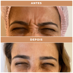 Antes e depois clnica performance Estética facial, Tratamentos corporais, preenchimentos, Massagens terapêuticas, Rejuvenescimento, Remoção de pelos, Contorno corporal, Terapias de bem-estar, Anti-envelhecimento, Estética avançada e muito mais procedimentos estéticos e saúde para seu corpo.