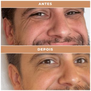 Antes e depois clnica performance Estética facial, Tratamentos corporais, preenchimentos, Massagens terapêuticas, Rejuvenescimento, Remoção de pelos, Contorno corporal, Terapias de bem-estar, Anti-envelhecimento, Estética avançada e muito mais procedimentos estéticos e saúde para seu corpo.