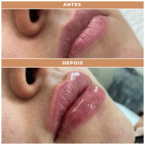 Antes e depois clnica performance Estética facial, Tratamentos corporais, preenchimentos, Massagens terapêuticas, Rejuvenescimento, Remoção de pelos, Contorno corporal, Terapias de bem-estar, Anti-envelhecimento, Estética avançada e muito mais procedimentos estéticos e saúde para seu corpo.