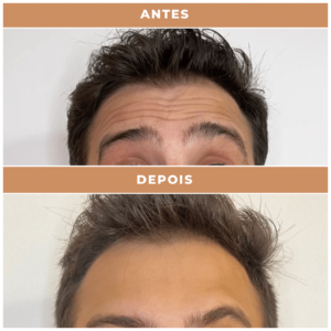 Antes e depois clnica performance Estética facial, Tratamentos corporais, preenchimentos, Massagens terapêuticas, Rejuvenescimento, Remoção de pelos, Contorno corporal, Terapias de bem-estar, Anti-envelhecimento, Estética avançada e muito mais procedimentos estéticos e saúde para seu corpo.