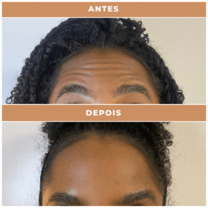 Antes e depois clnica performance Estética facial, Tratamentos corporais, preenchimentos, Massagens terapêuticas, Rejuvenescimento, Remoção de pelos, Contorno corporal, Terapias de bem-estar, Anti-envelhecimento, Estética avançada e muito mais procedimentos estéticos e saúde para seu corpo.